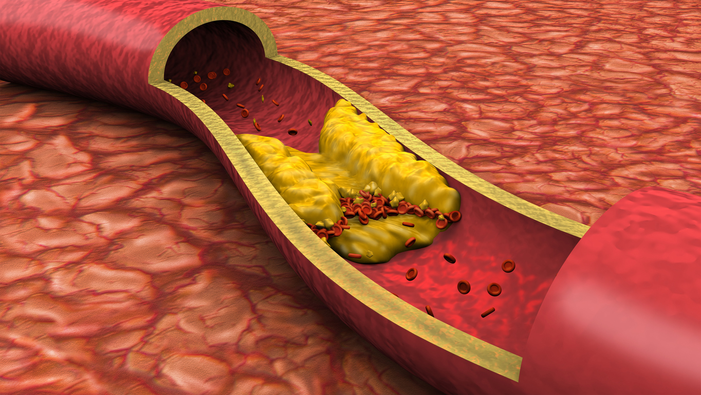 Clogged artery low angled view shown with a cut out section displaying fat deposits and a formed clot. High quality rendering with original hand painted textures and global illumination with great detail.