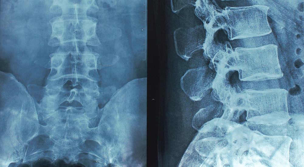 x-ray of the spine lumbar sacral