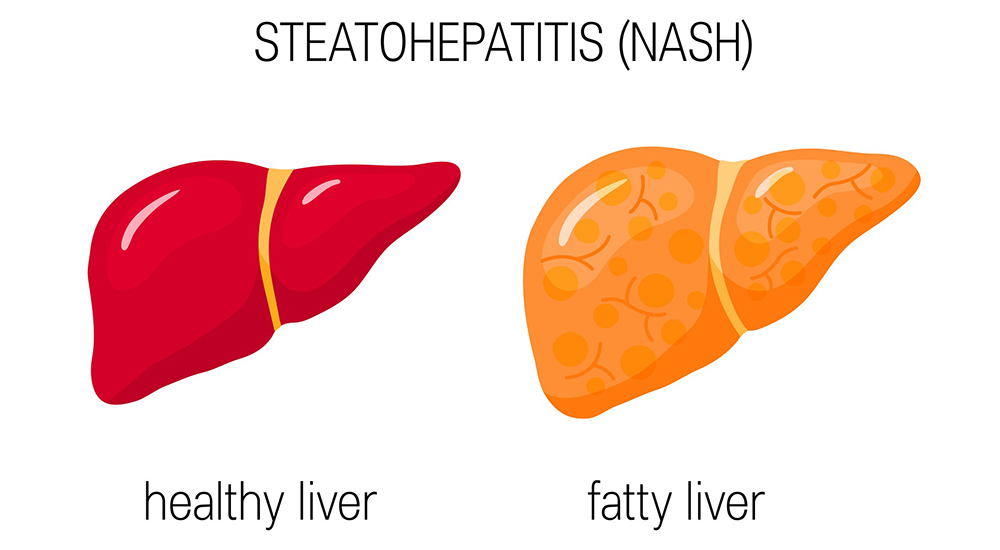 Non-alcoholic steatohepatitis (NASH). Vector illustration of a healthy and a fatty liver in flat style