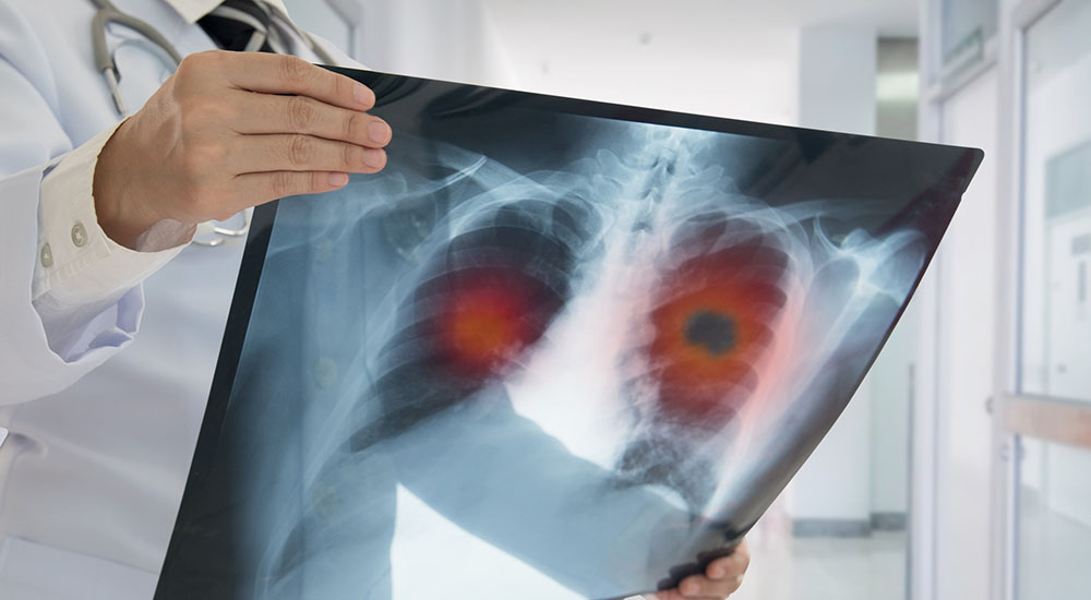 Man holding x-ray of lungs with cancer