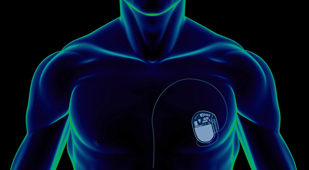 Design of human torso showing pacemaker