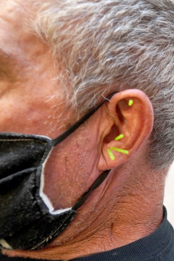 Man’s ear with acupuncture needles