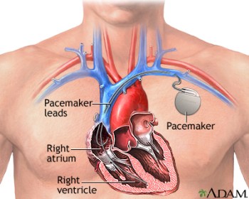 Dr. Chardack and colleagues invented the first successful cardiac pacemaker.
