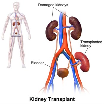 Dr. Starzl carried out his first kidney transplant in 1962