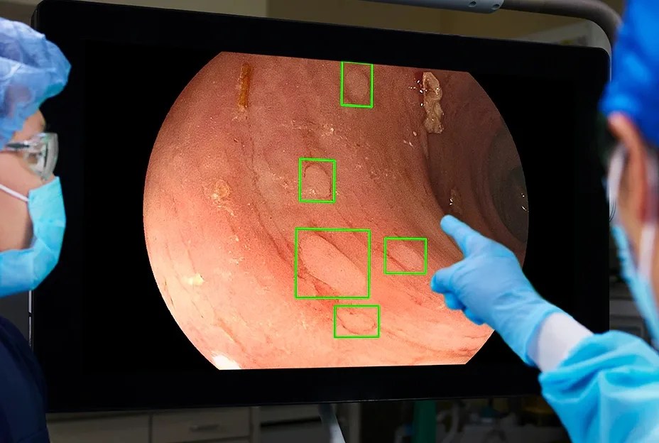 VA deploys Artificial Intelligence to increase pre-cancerous polyp detection rate for colorectal cancer