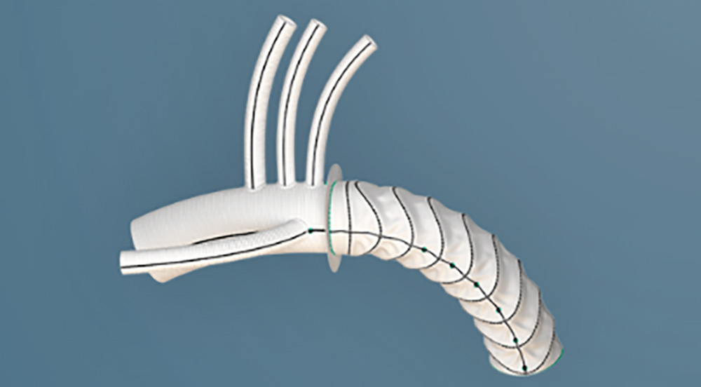 Cardiac device called Thoraflex Hybrid Frozen Elephant Trunk