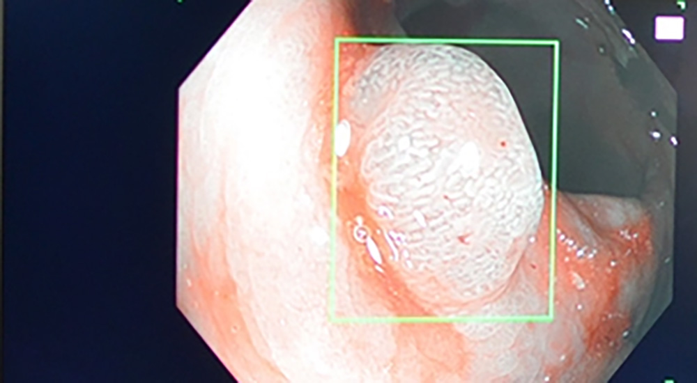 cancer polyp detected with Artificial Intelligence; colonoscopy