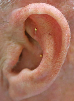 Ear with battlefield acupuncture 