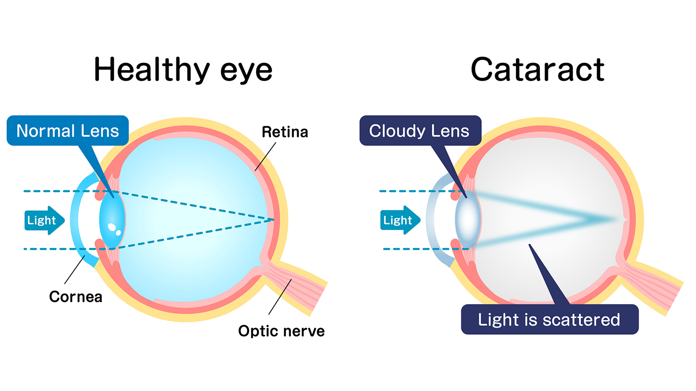 Veteran with LVAD has cataract surgery