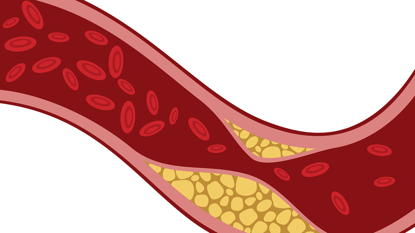 Cholesterol graphic