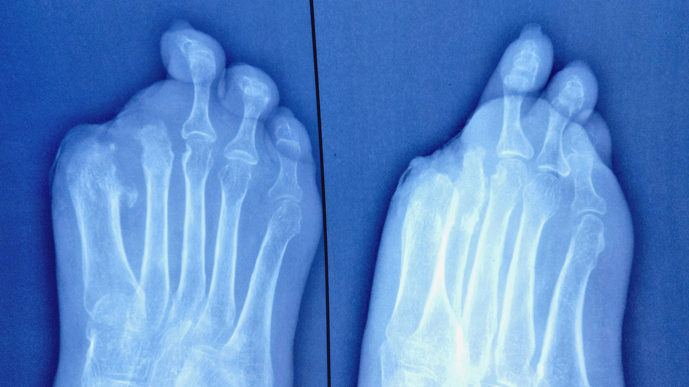 Feet X-ray; diabetes amputation